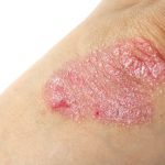 Psoriasis