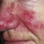 Rosacea